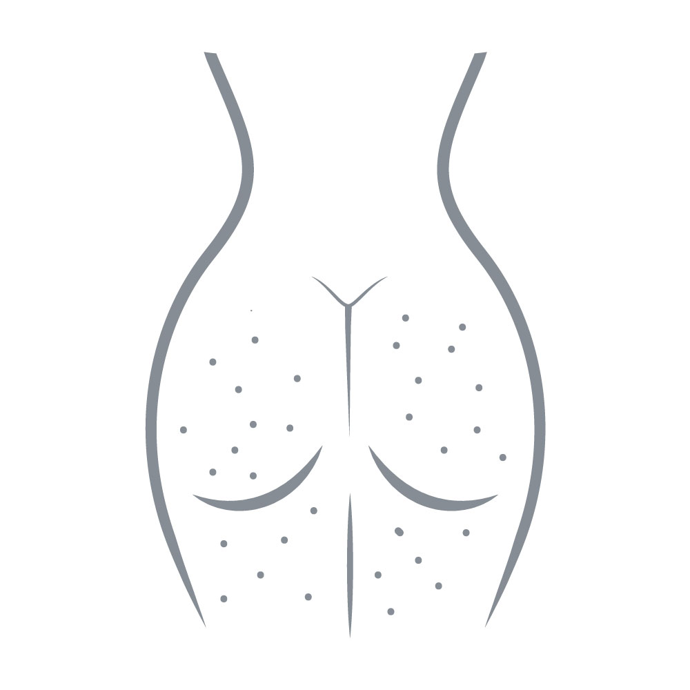 carbossiterapia-per-cellulite-andrea-maria-florio