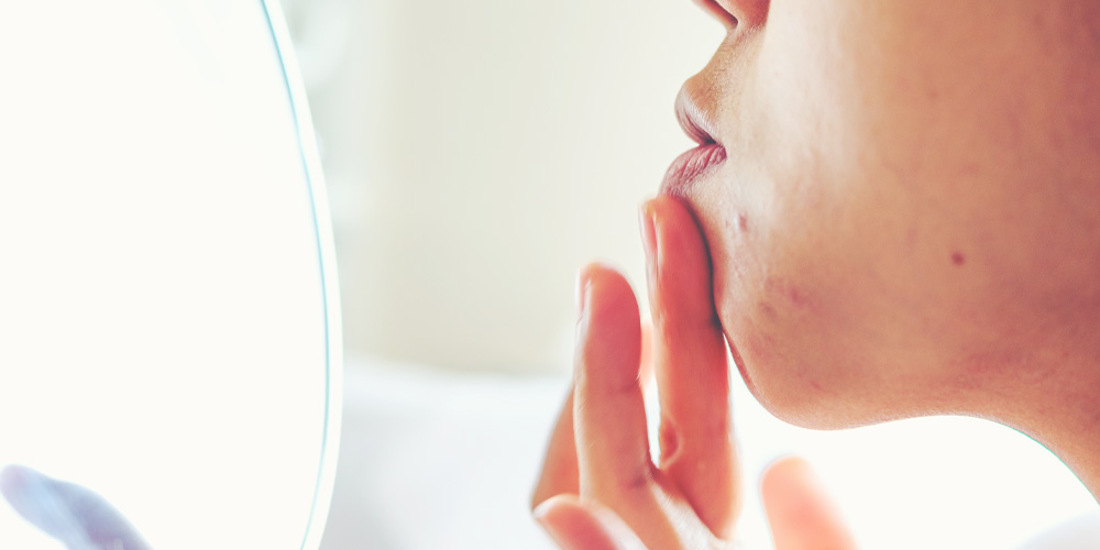 acido-ialuronico-come-rimedio-cicatrice-acne-andrea-maria-florio