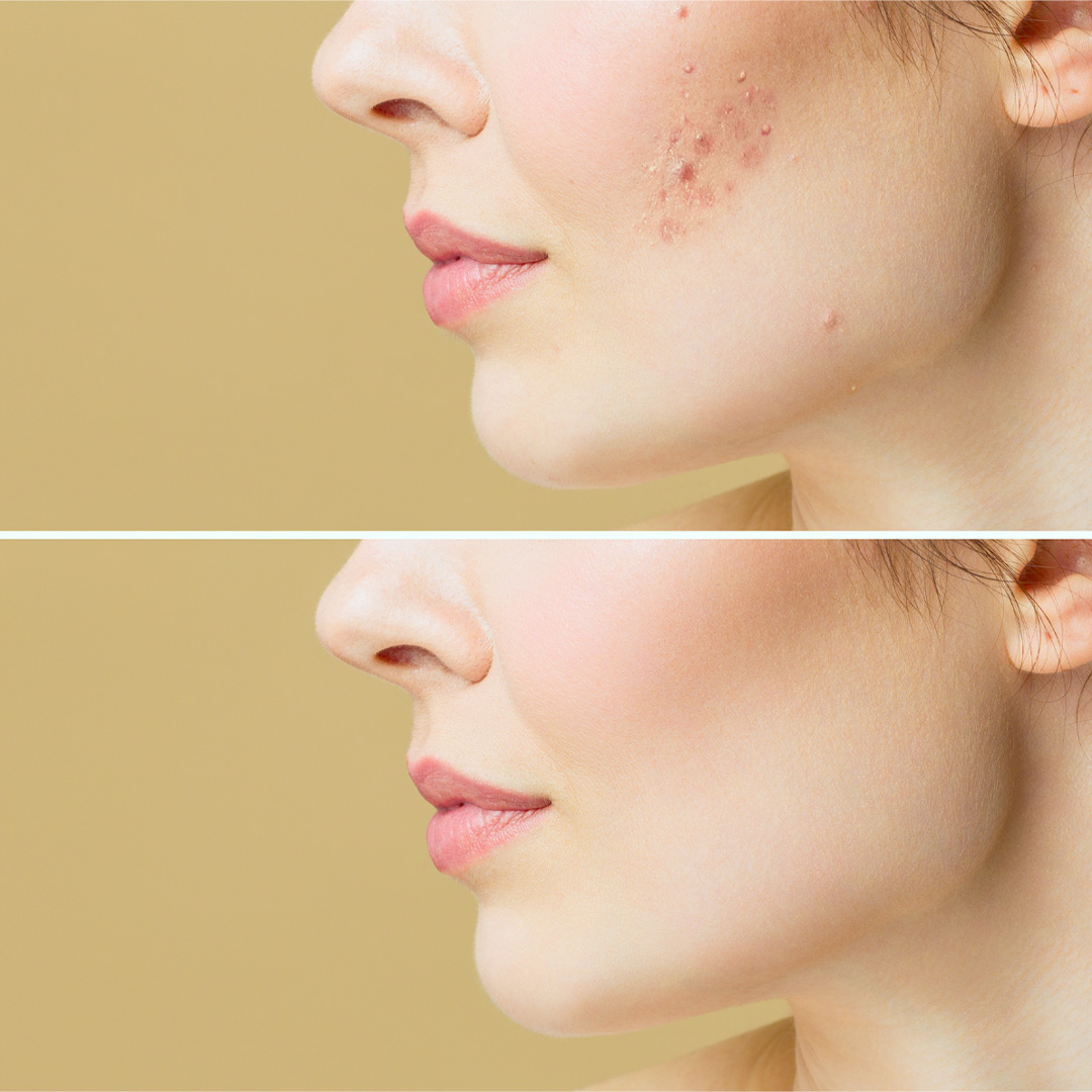 cicatrici-acne-medicina-estetica-andrea-maria-florio cicatrici-acne-medicina-estetica-andrea-maria-florio
